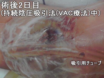 術後2日目(持続陰圧吸引法(VAC療法)中)